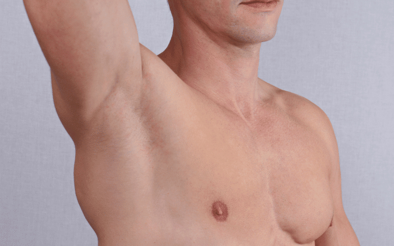 Gynecomastia The Impact of Liver Disease on Hormone Balance