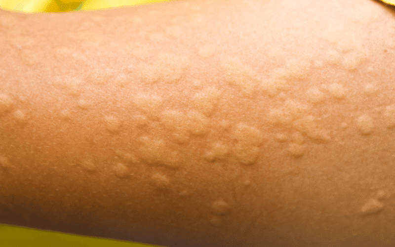 Hives (Urticaria) The Itchy Outbreak