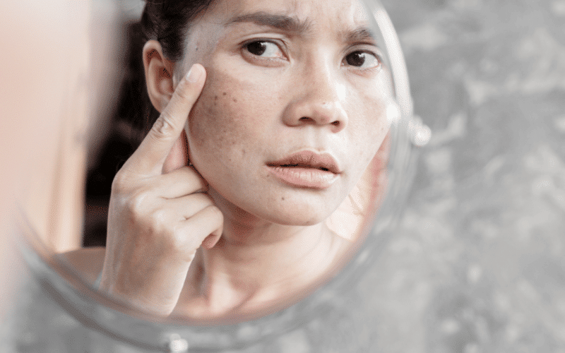 Hyperpigmentation and Hypopigmentation The Skin Color Dilemma