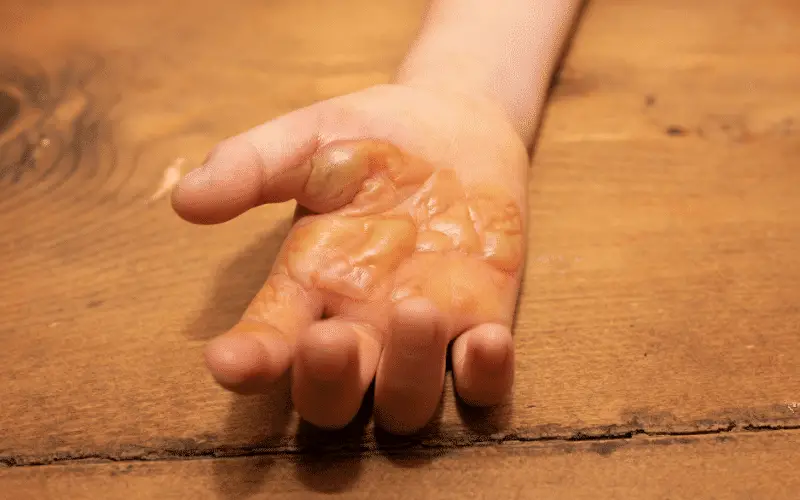 Itchy Blisters on the Hands and Feet The Hallmark Sign of Dyshidrotic Eczema