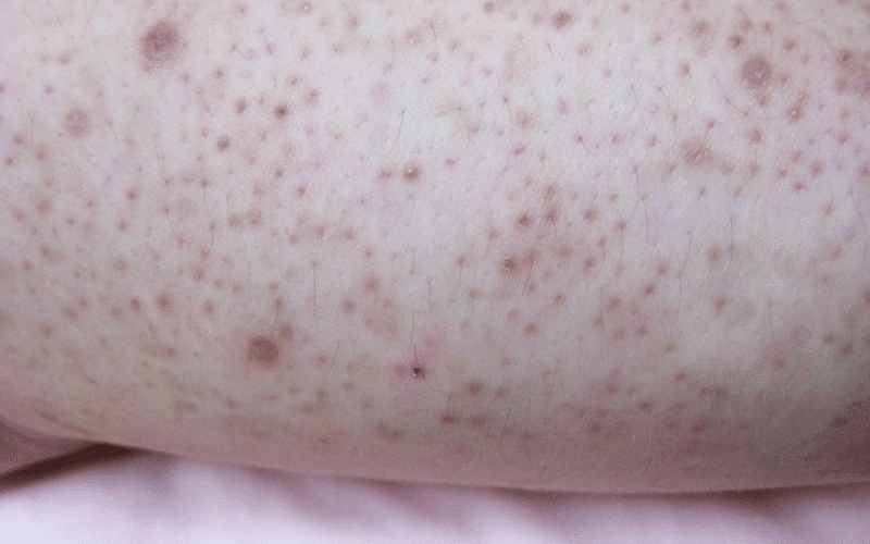 Keratosis Pilaris A Common, Harmless Skin Condition