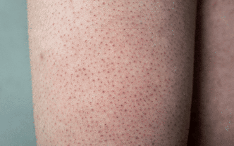 Keratosis Pilaris A Rough Skin Texture