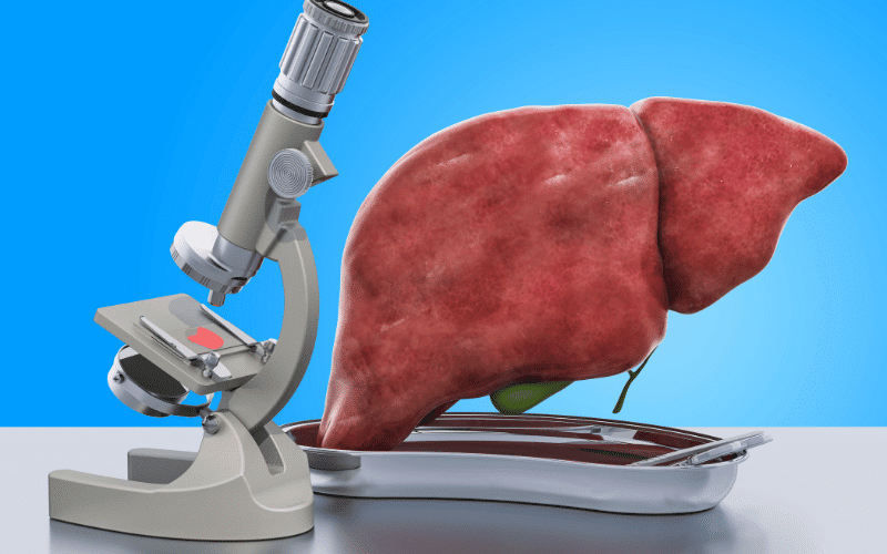 Liver Disease A Hidden Factor in Macrocytic Anemia