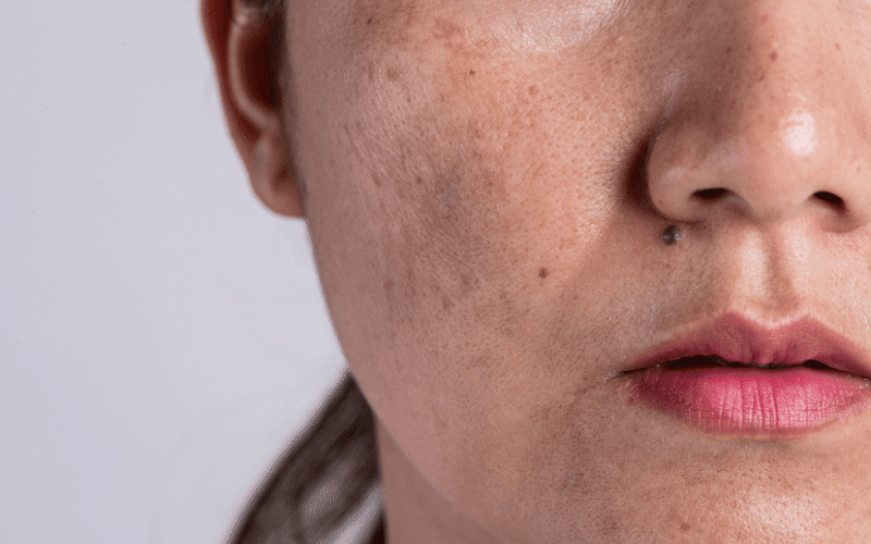 Melasma Hyperpigmentation of the Skin