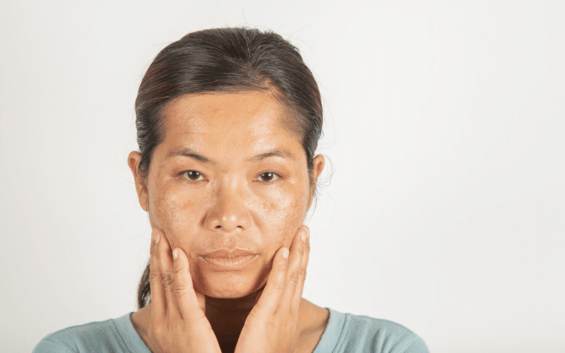 Melasma The Mask of Pregnancy