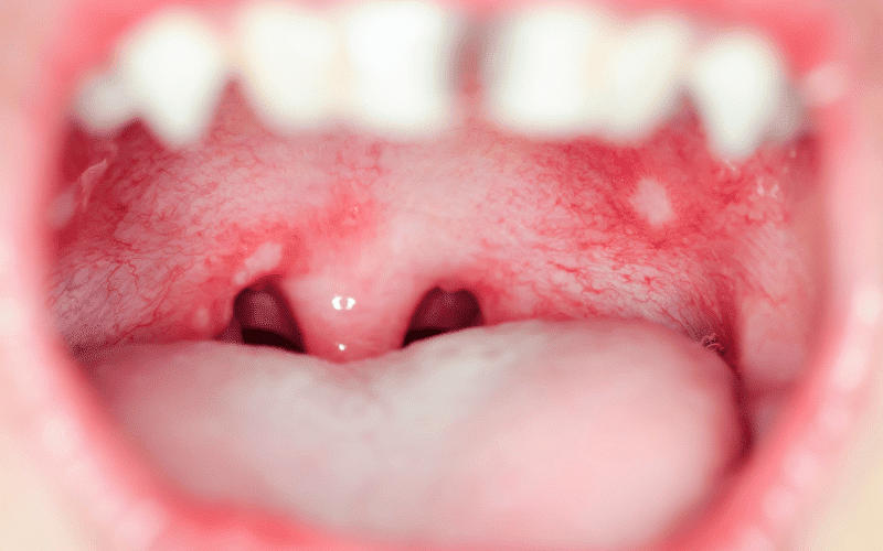 Mouth Sores and Cracks