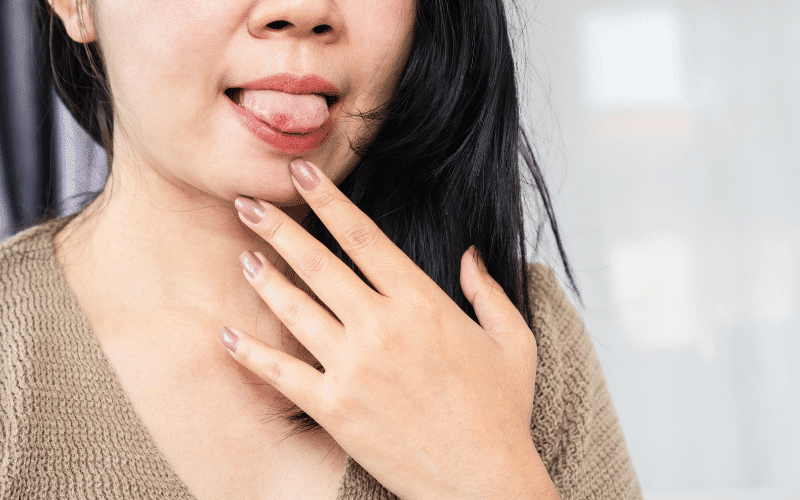 Oral and Nasal Ulcers Painful Sores in SLE Patients