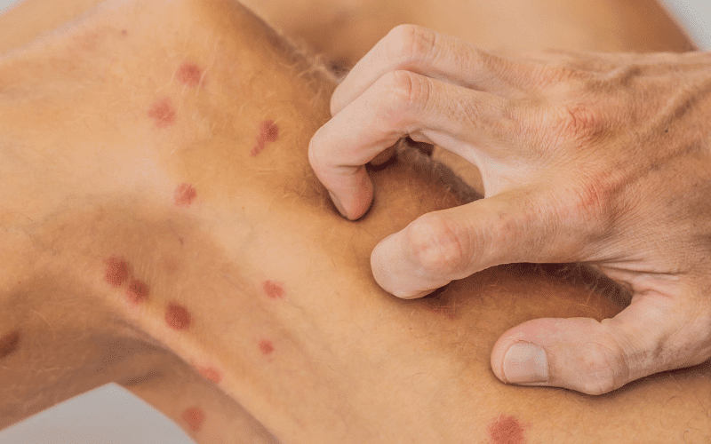 Petechiae