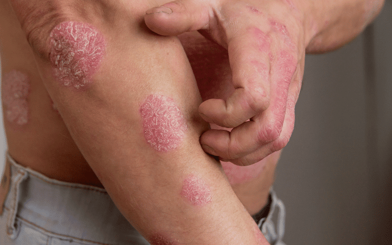 Psoriasis An Immune-Mediated Skin Condition