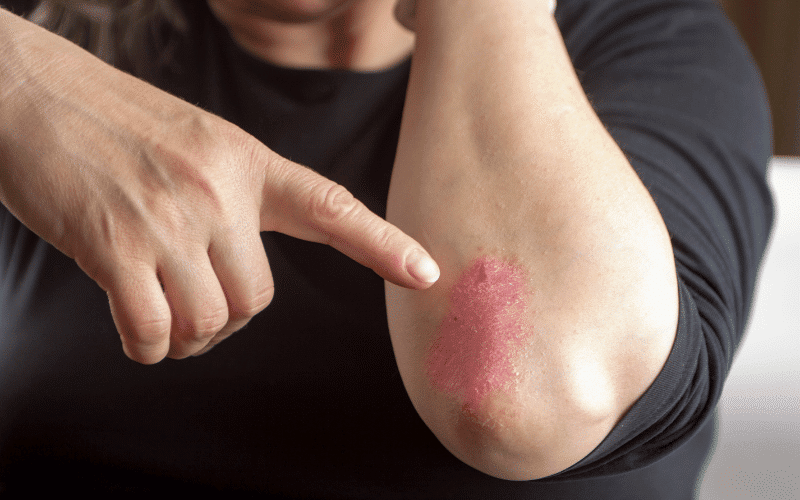 Psoriasis - An Immune-Mediated Skin Disorder