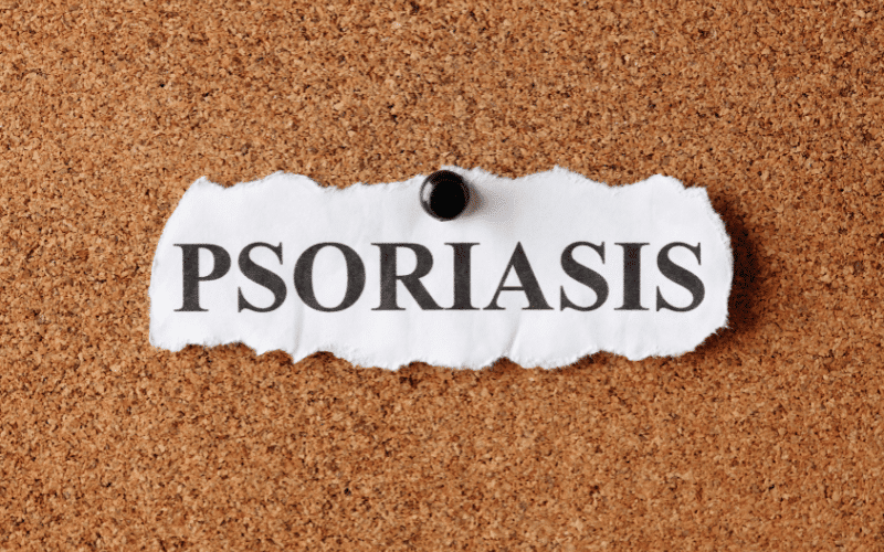 Psoriasis More Than Skin Deep