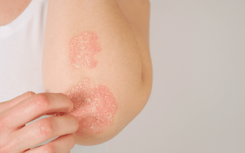 Psoriasis The Persistent, Scaly Skin Disorder