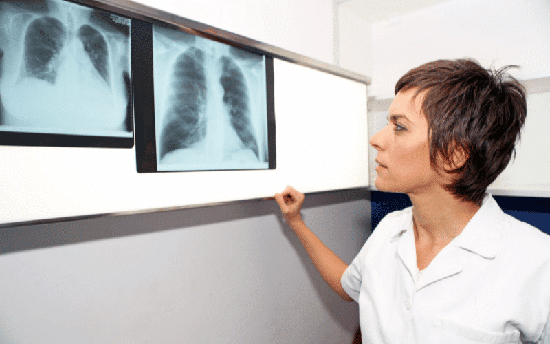 Pulmonary Hypertension A Serious Complication for Thalassemia Patients