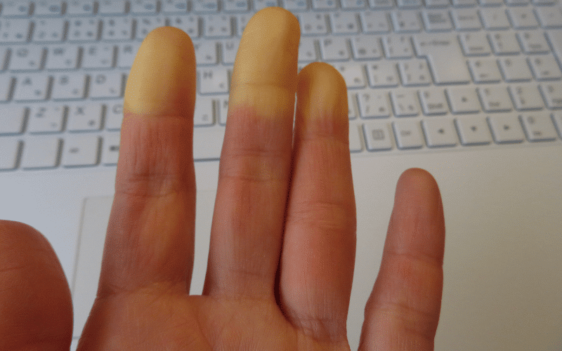 Raynaud’s Phenomenon - A Tale of Cold Fingers and Toes