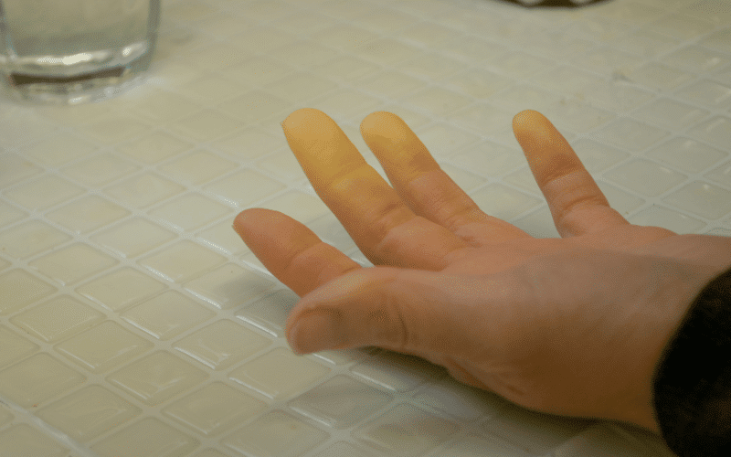 Raynaud’s Phenomenon