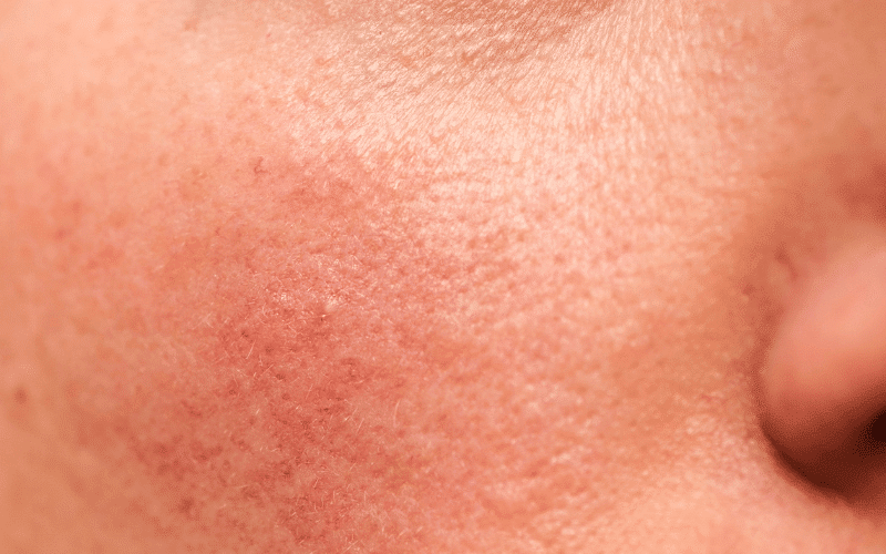Red, Inflamed Skin
