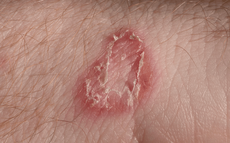 Ringworm - A Misleading Name for a Common Fungal Infection