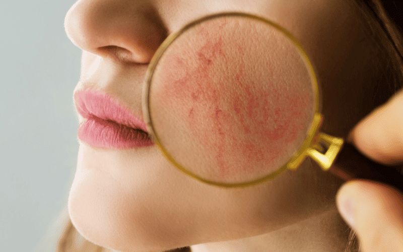 Rosacea A Chronic Inflammatory Skin Disorder