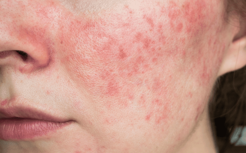 Rosacea The Red-Faced Intruder