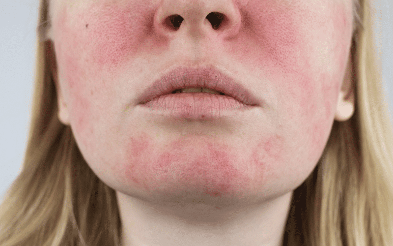 Rosacea The Red-Faced Skin Disorder