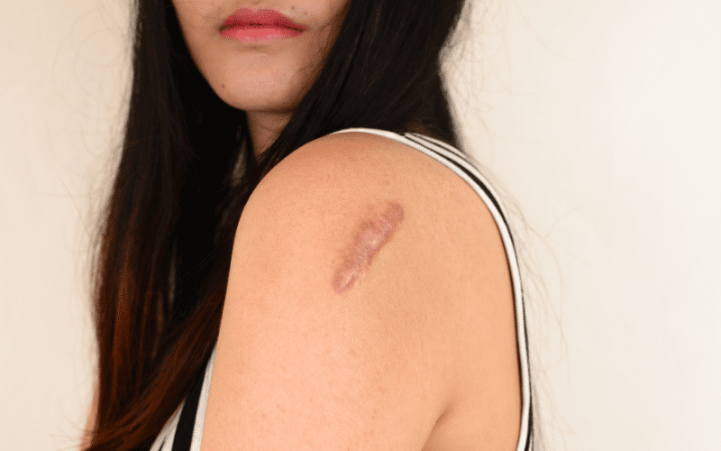 Satellite Lesions The Spread of Ringworm Infections