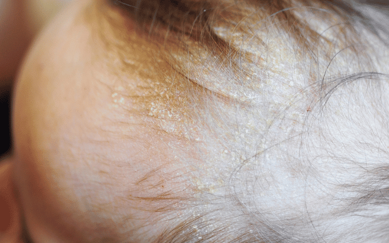 Seborrheic Dermatitis When Dandruff Goes Beyond the Scalp