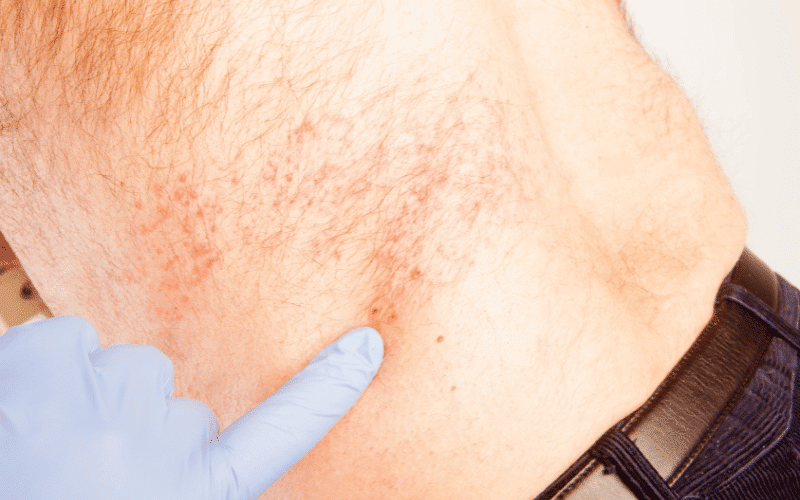 Shingles A Painful Viral Skin Rash