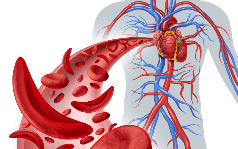 Sickle Cell Anemia A Genetic Blood Disorder