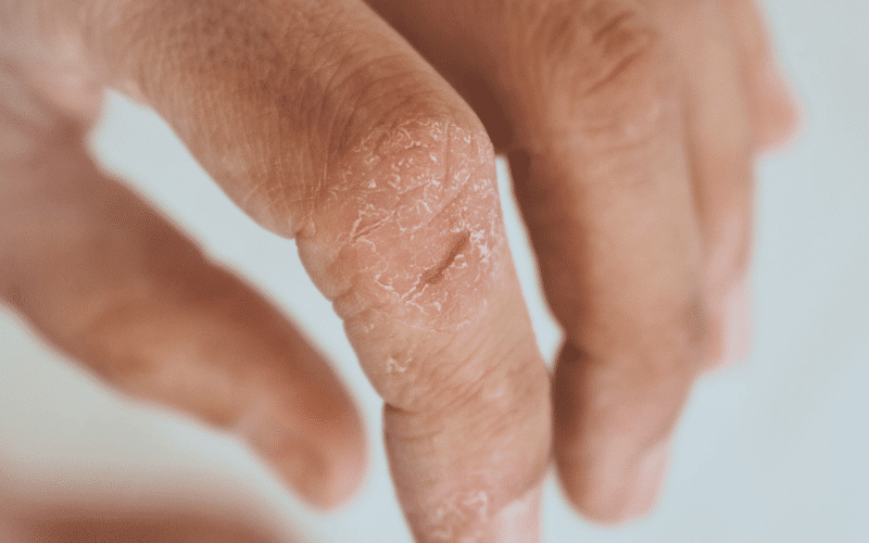 Skin Cracking and Fissures The Painful Reality of Dyshidrotic Eczema