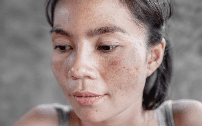 Skin Discoloration