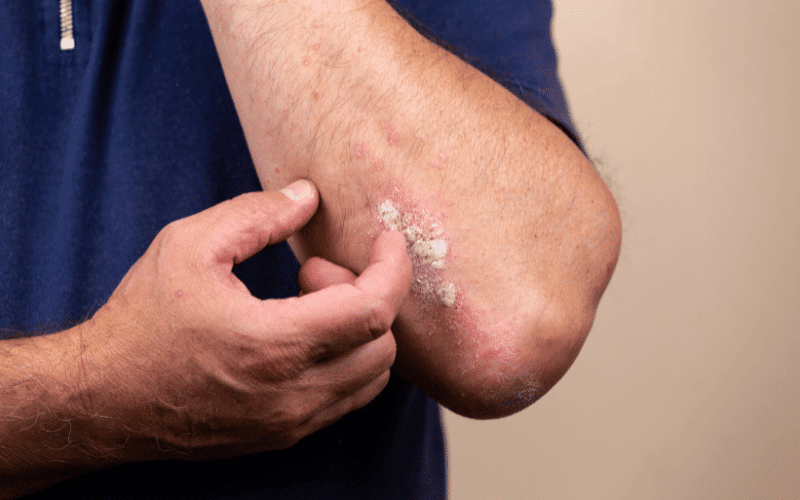 Skin Peeling and Scaling The Ongoing Cycle of Dyshidrotic Eczema