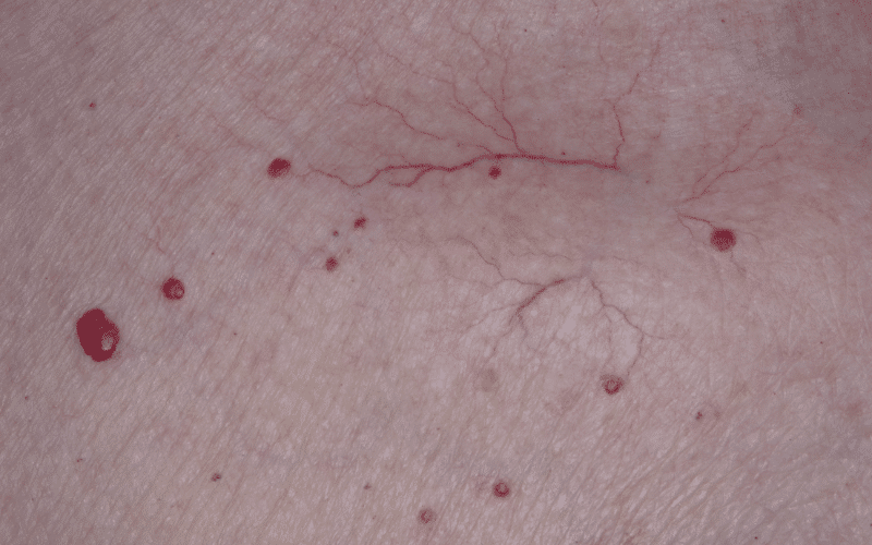 Spider Angiomas Small but Telling Signs of Liver Disease