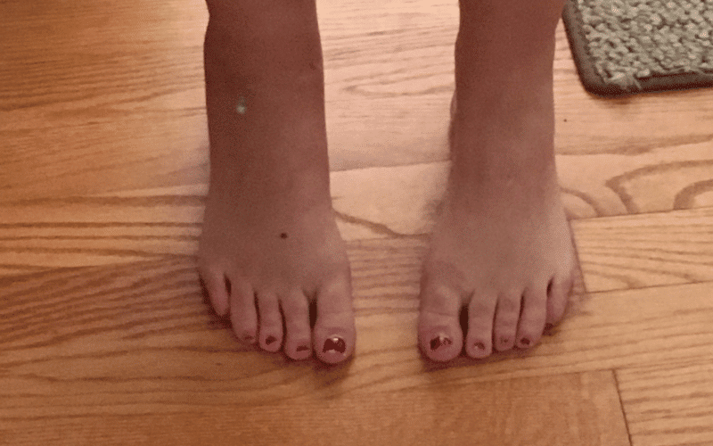 Swelling in the Legs and Ankles A Sign of Liver-Related Fluid Retention