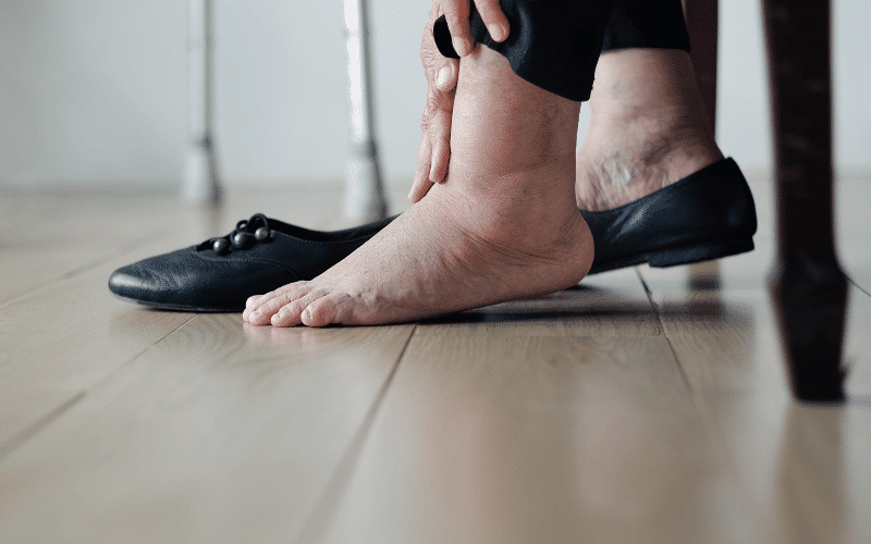 Swelling in the Legs and Ankles - The Troublesome Fluid Retention