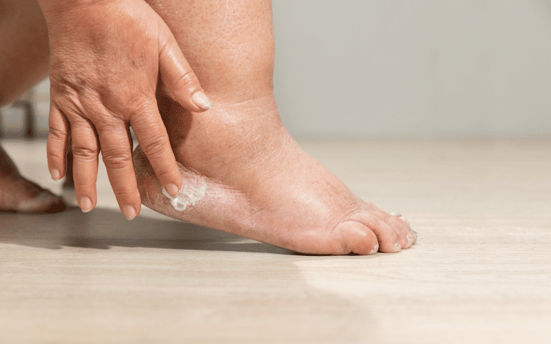 Swollen Legs and Ankles The Fluid Retention Connection to Liver Problems