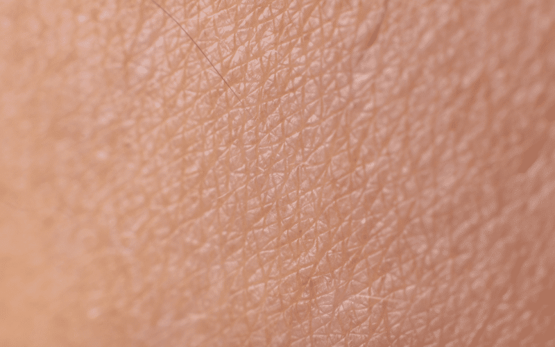 Thickened Skin A Result of Chronic Eczema