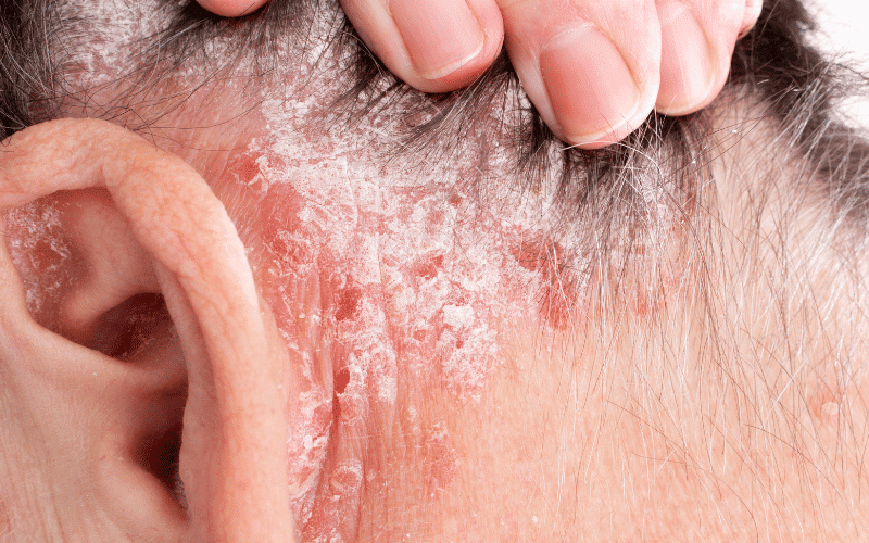 Thickened Skin The Long-Term Impact of Dyshidrotic Eczema