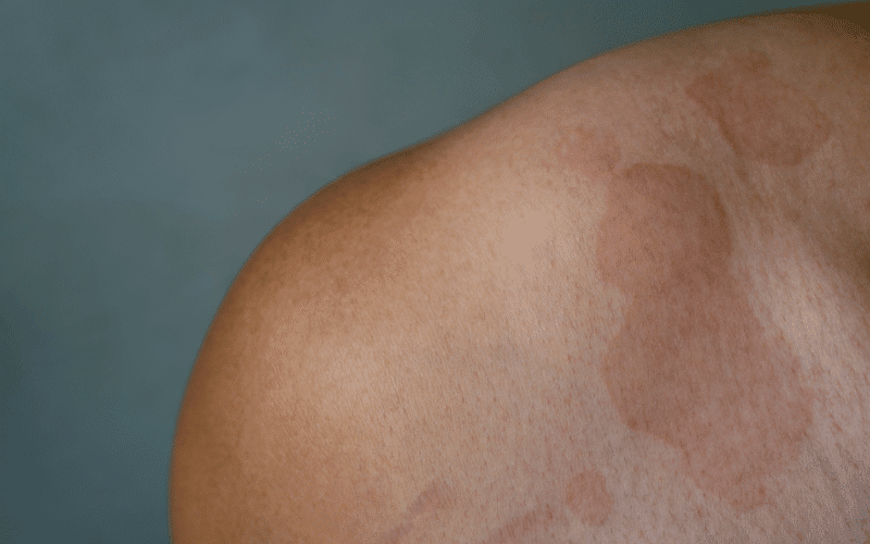 Tinea Versicolor The Discolored Patches