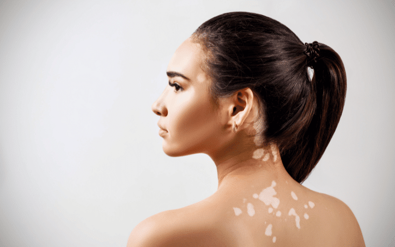 Vitiligo A Tale of Disappearing Pigment