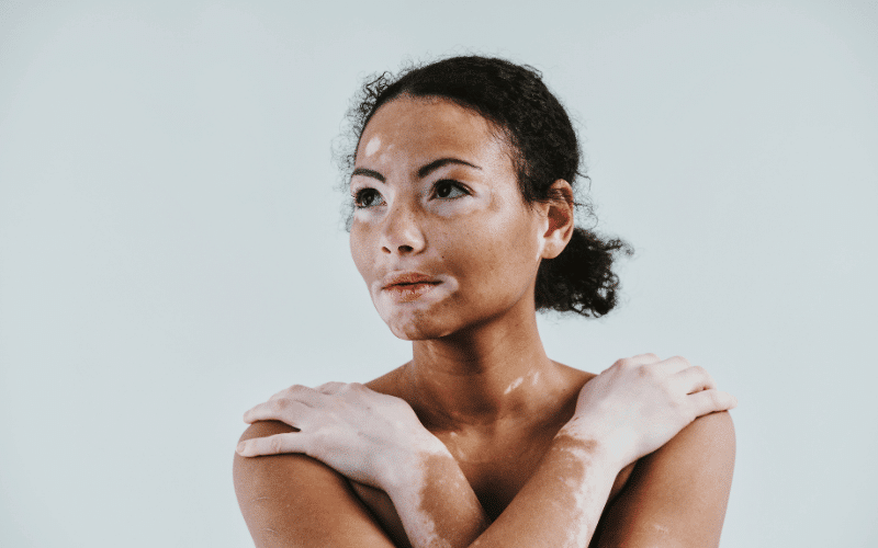 Vitiligo An Autoimmune Skin Condition Affecting Pigmentation