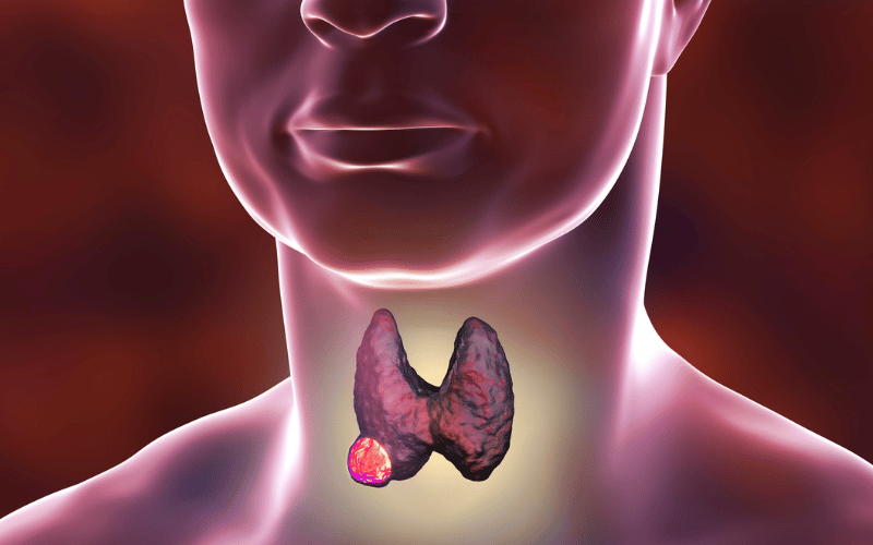 Recognizing the 10 Symptoms of Thyroid Cancer in Men