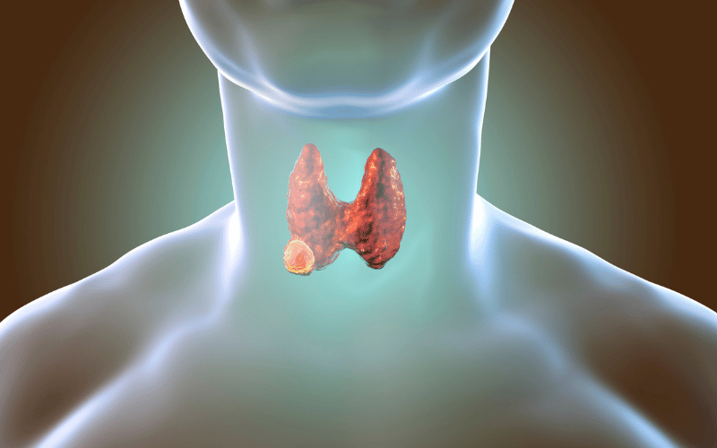Spotting Anaplastic Thyroid Cancer (ATC) 10 Crucial Symptoms You Can't Afford to Miss