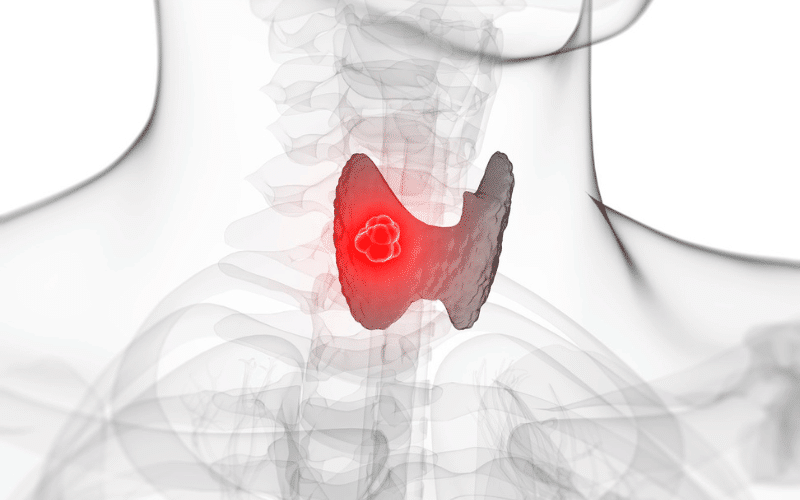 Thyroid Cancer Survival Toolkit 15 Treatment Options to Know