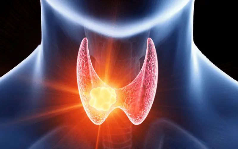 Thyroid Nodules Ten Critical Facts You Should Know