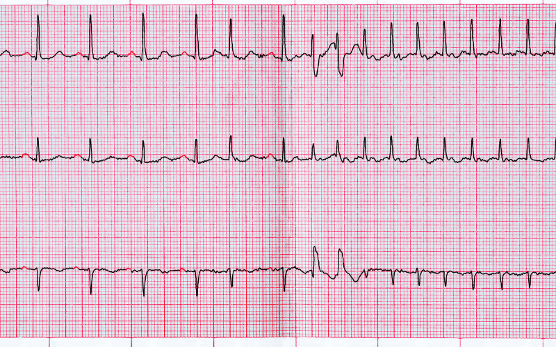 Irregular Heartbeat – The Erratic Drummer