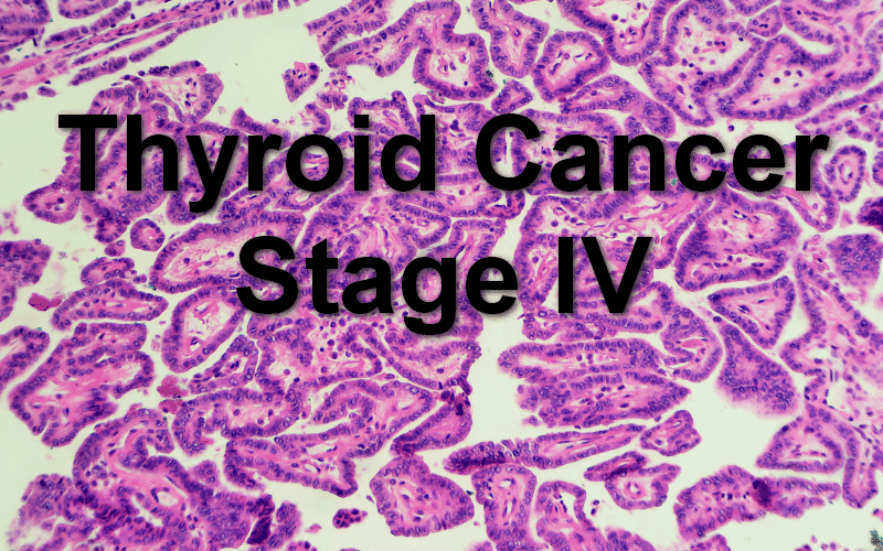 The Pinnacle Stage IV Thyroid Cancer