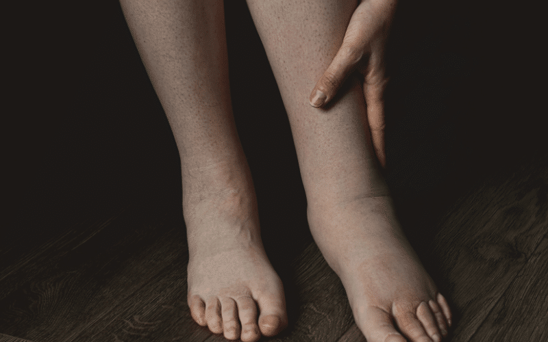 Unwanted Retention – Swelling (Edema) in Legs, Ankles, and Feet