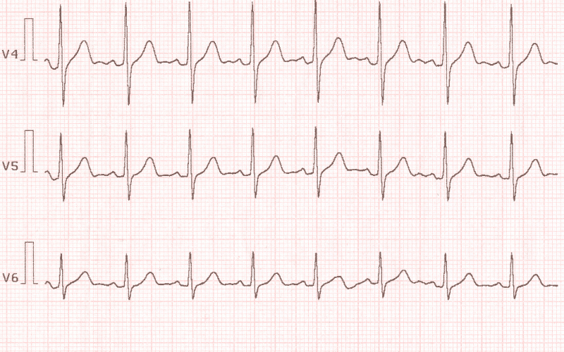 Rapid Heartbeat The Body's Response to Restrictive Cardiomyopathy