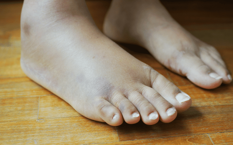 Swelling in the Legs, Ankles, and Feet – The Telltale Puffiness