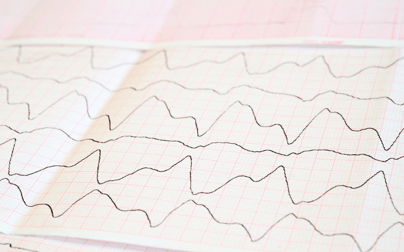 Unstable Heart Rate A Beat Out of Sync